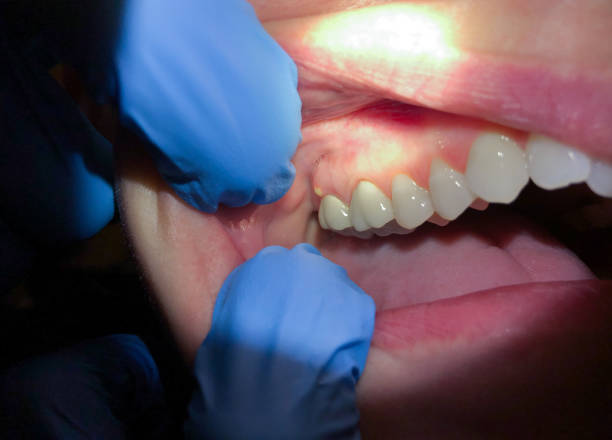 Best Emergency Tooth Extraction in Pandora, OH